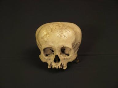 Deformierter Schädel