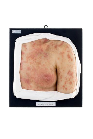 Pityriasis rubra pilaris