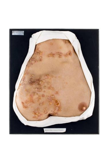 Dermatitis herpetiformis