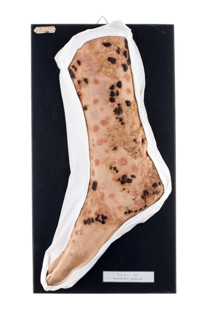 Lues III verruköses Syphilid