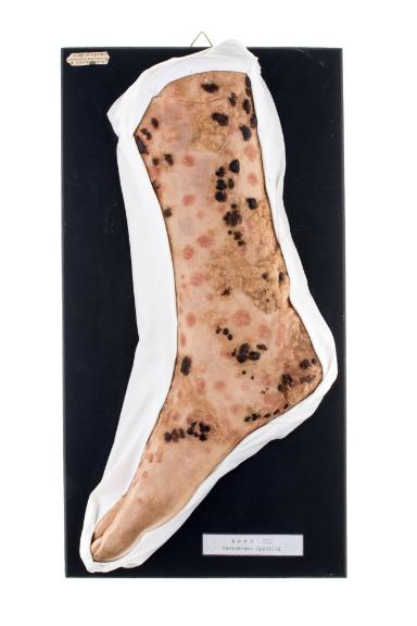 Lues III verruköses Syphilid