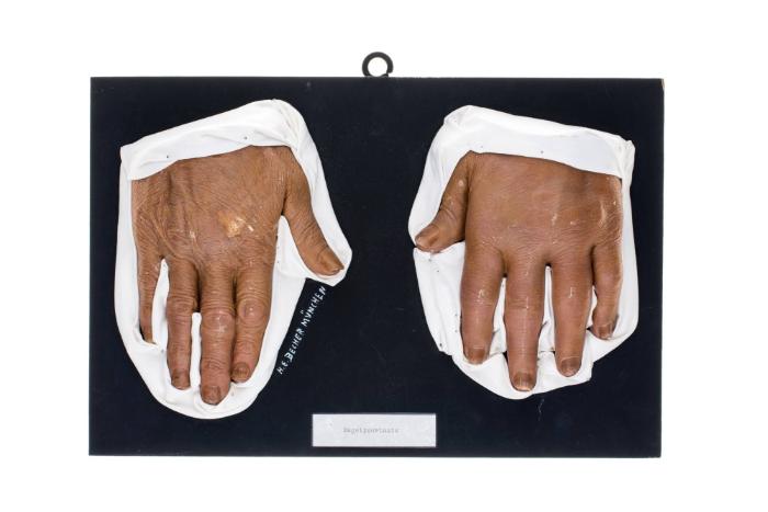 Nagelpsoriasis