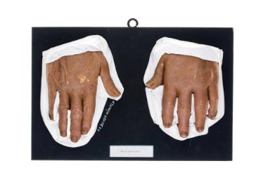 Nagelpsoriasis