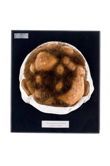 Trichophytis profunda (Kerion Celsi)