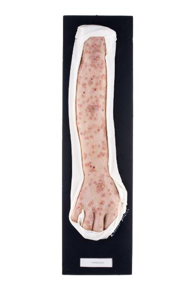 Varicellen