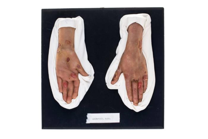 Epidermolysis bullosa
