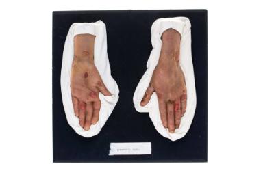 Epidermolysis bullosa