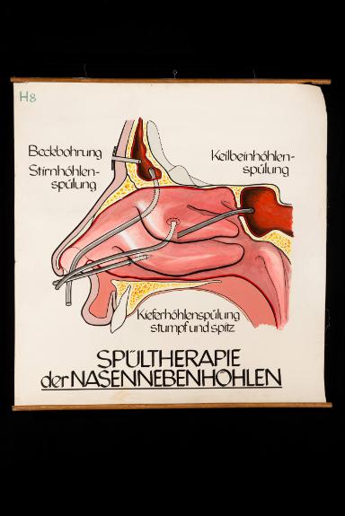 Spültherapie der Nasennebenhöhlen