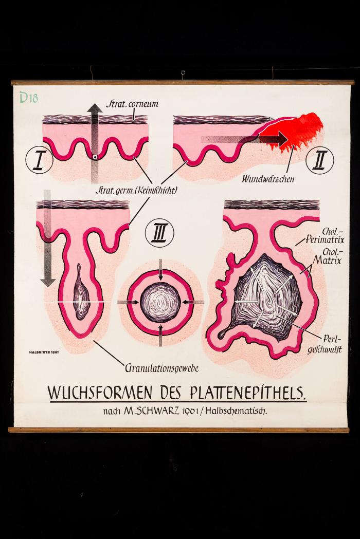 Wuchsformen des Plattenepithels nach M. Schwarz
