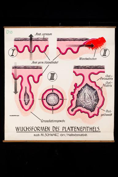 Wuchsformen des Plattenepithels nach M. Schwarz