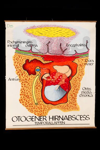 Otogener Hirnabszess, Temporallappen