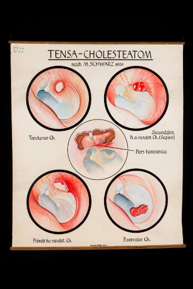 Tensa-Cholesteatom nach M. Schwarz
