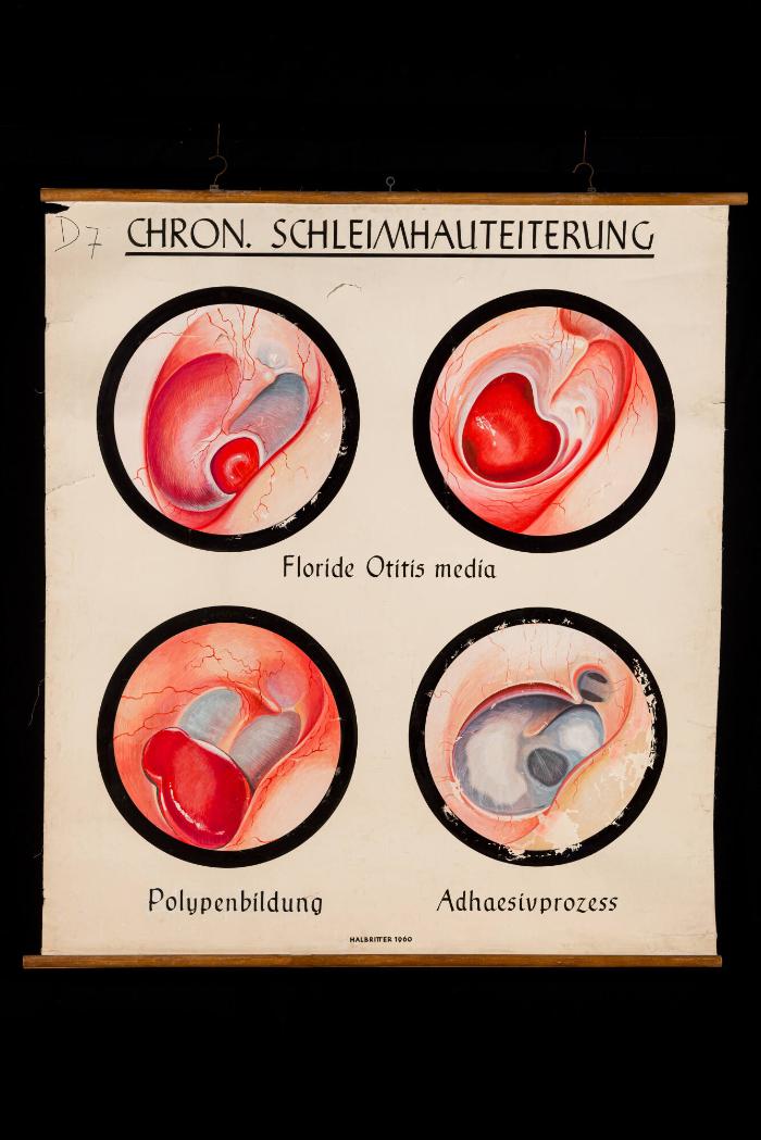 Ausprägungen der chronischen Schleimhauteiterung