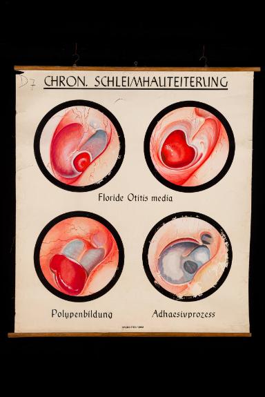 Ausprägungen der chronischen Schleimhauteiterung