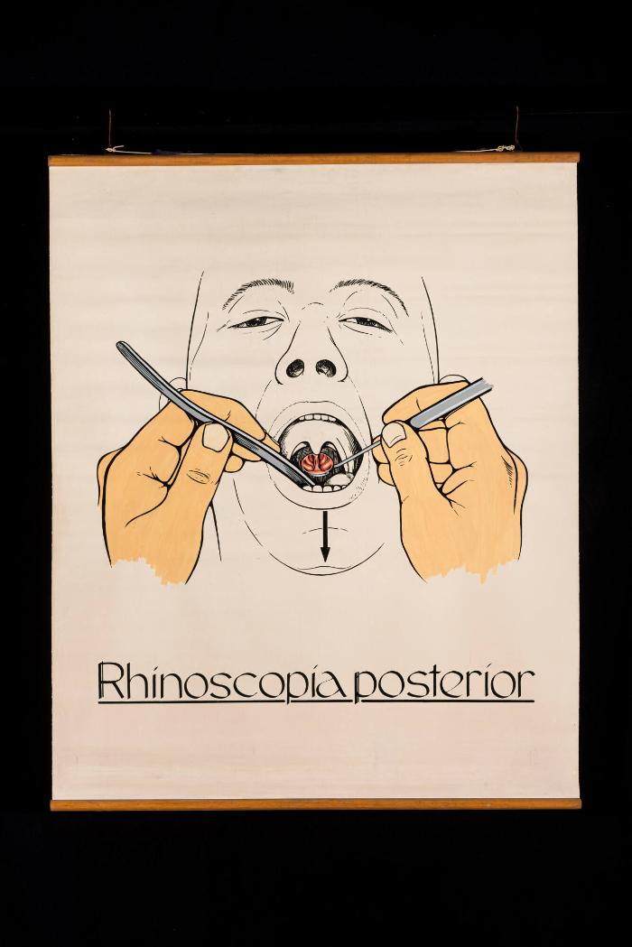 Indirekte Nasenracheninspektion (Rhinoscopia posterior)