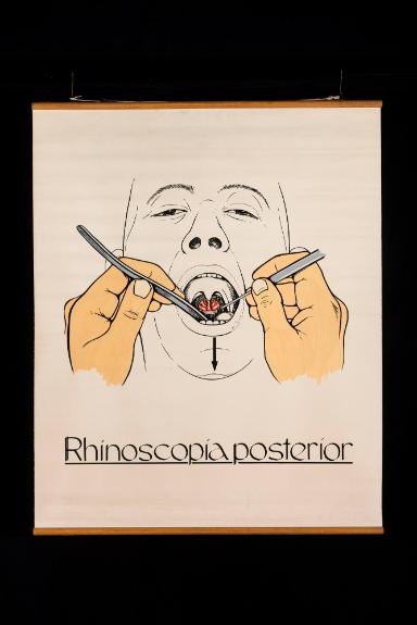Indirekte Nasenracheninspektion (Rhinoscopia posterior)