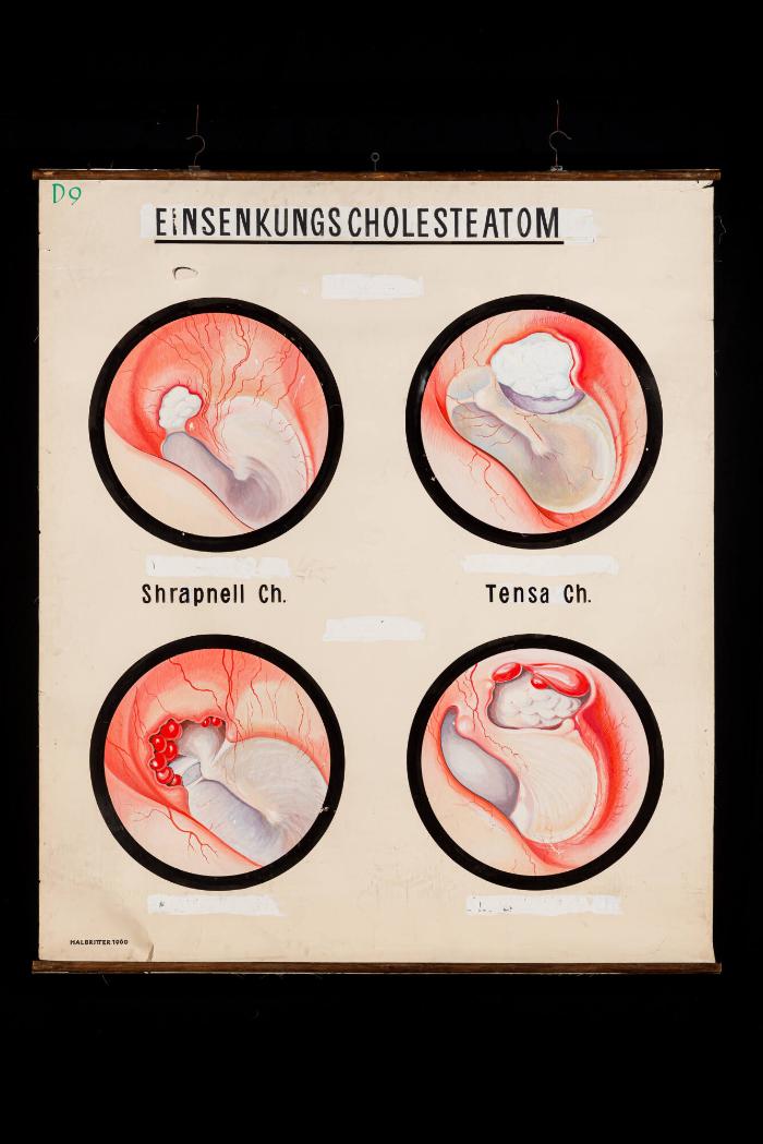 Einsenkungscholesteatom