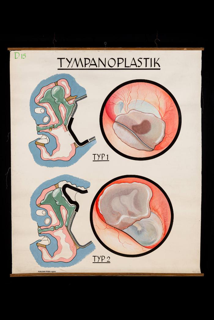 Tympanoplastik, Typ 1 und 2