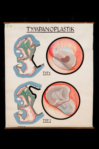 Tympanoplastik, Typ 1 und 2