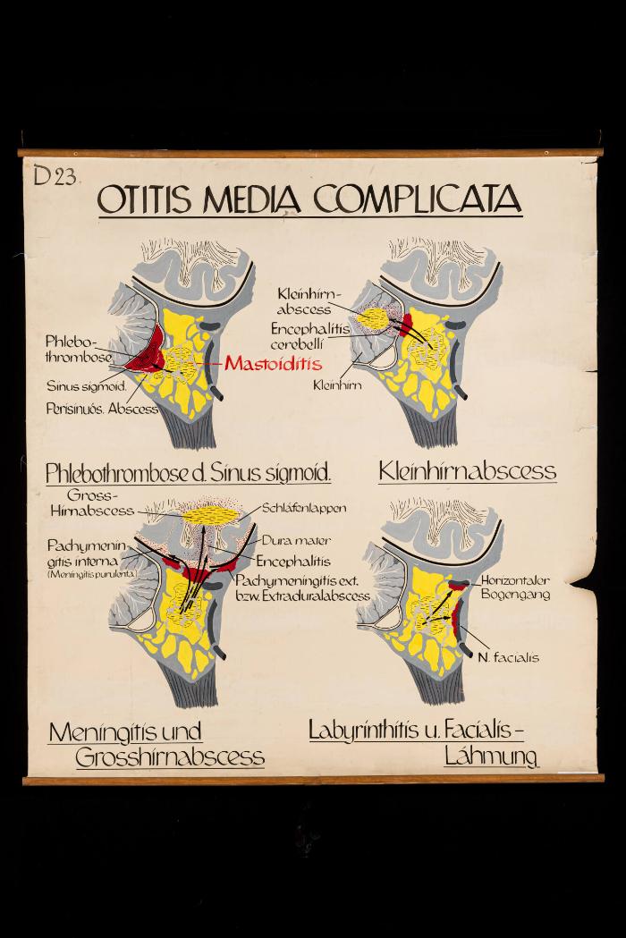 Otitis Media Complicata
