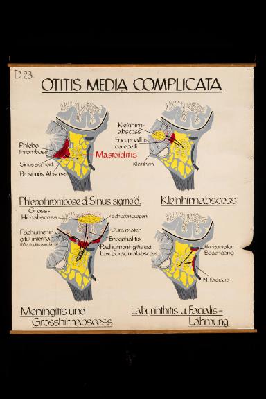 Otitis Media Complicata