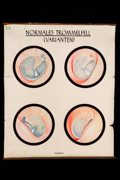 Varianten des normalen Trommelfells