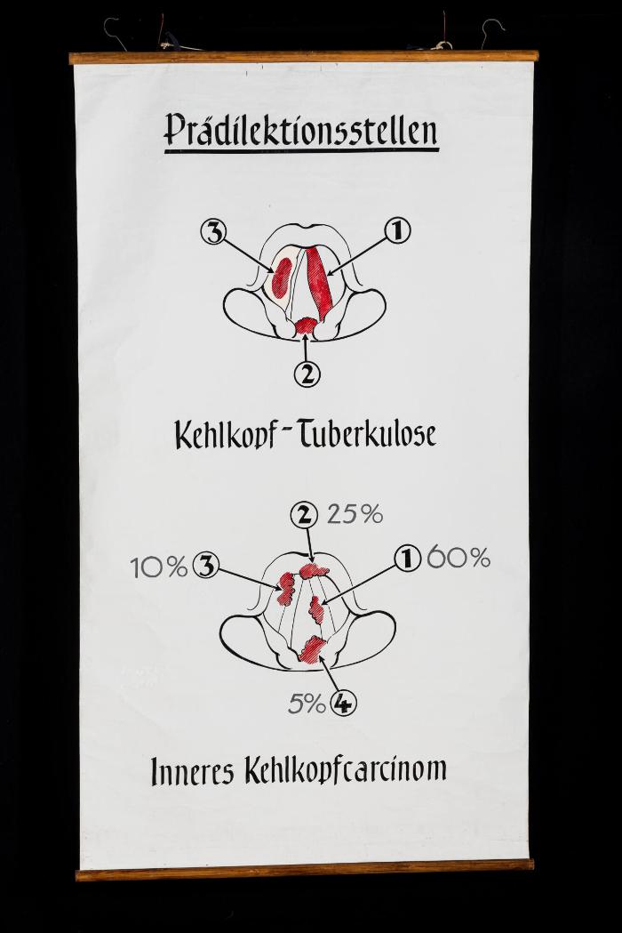 Prädilektionsstellen der Kehlkopf-Tuberkulose und des Kehlkopfcarcinoms