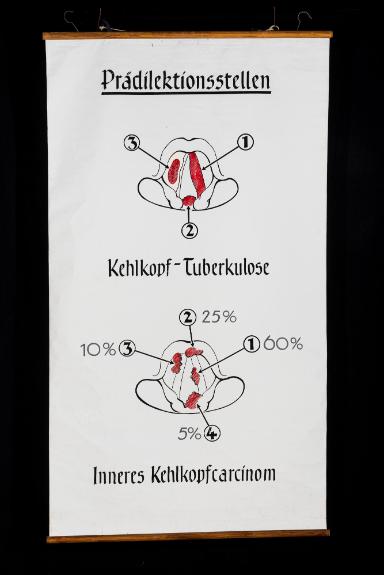 Prädilektionsstellen der Kehlkopf-Tuberkulose und des Kehlkopfcarcinoms