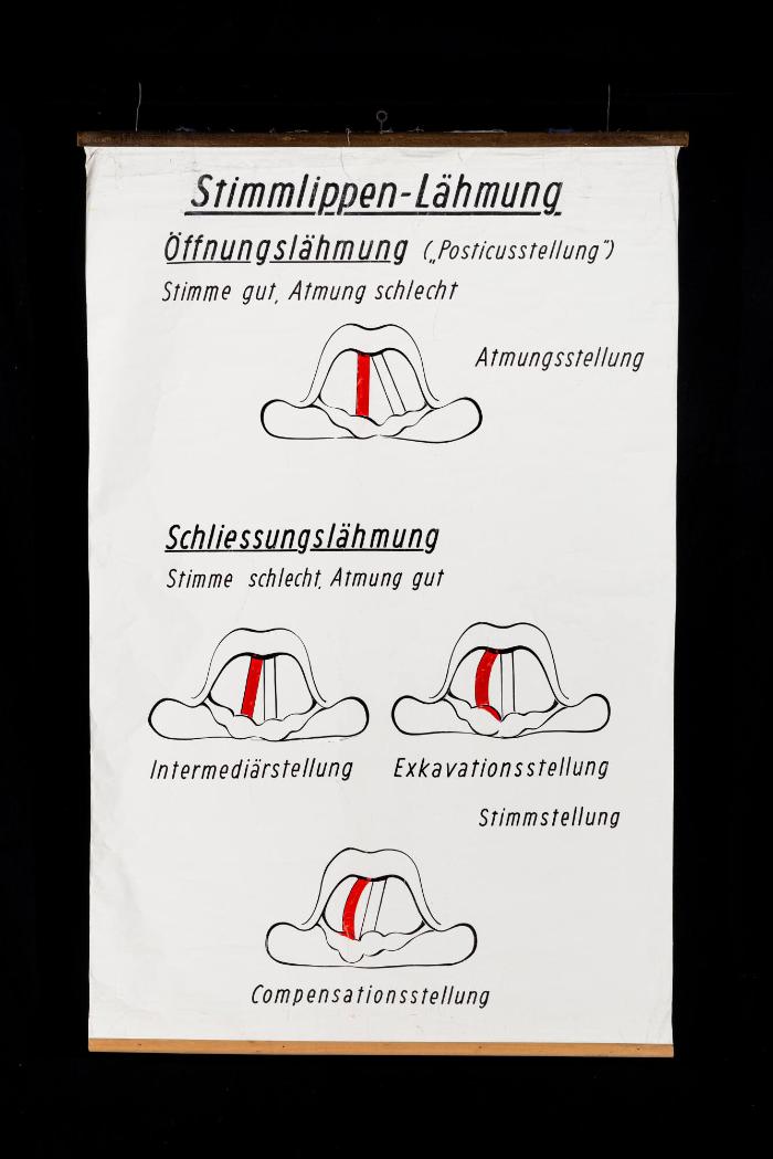 Schema der Stimmlippen-Lähmungen
