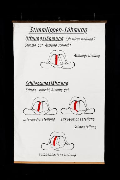 Schema der Stimmlippen-Lähmungen