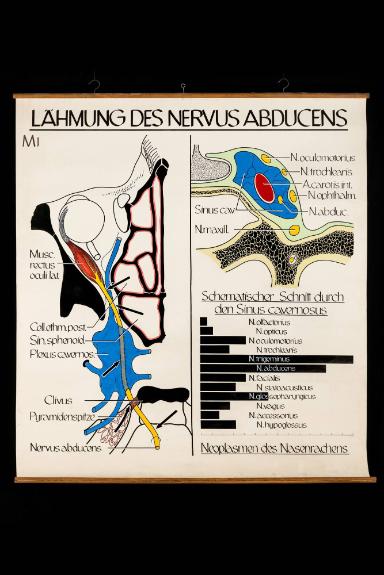 Lähmung des Nervus Abducens