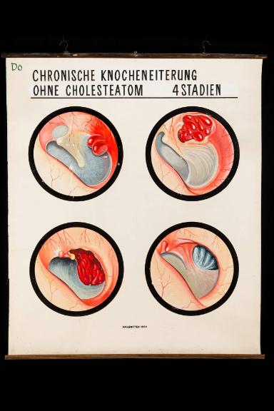 Stadien der chronischen Knocheneiterung ohne Cholesteatom