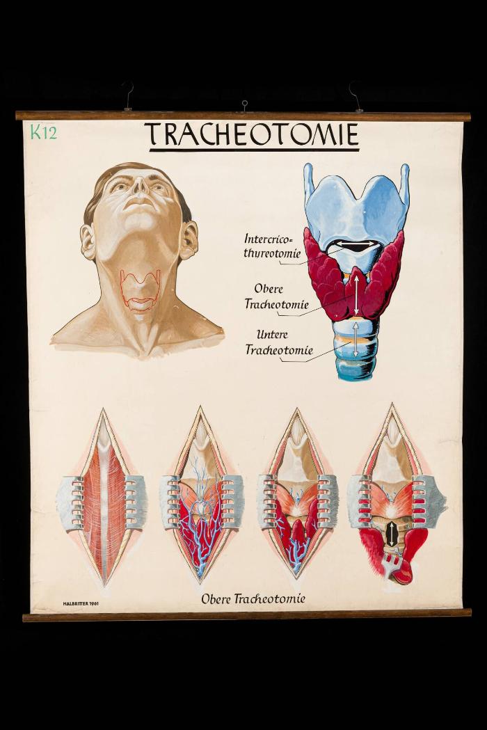 Tracheotomie