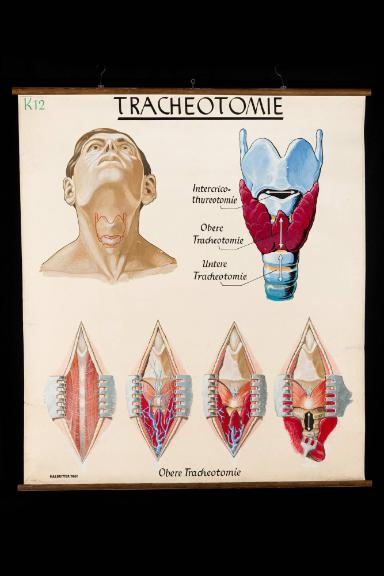 Tracheotomie