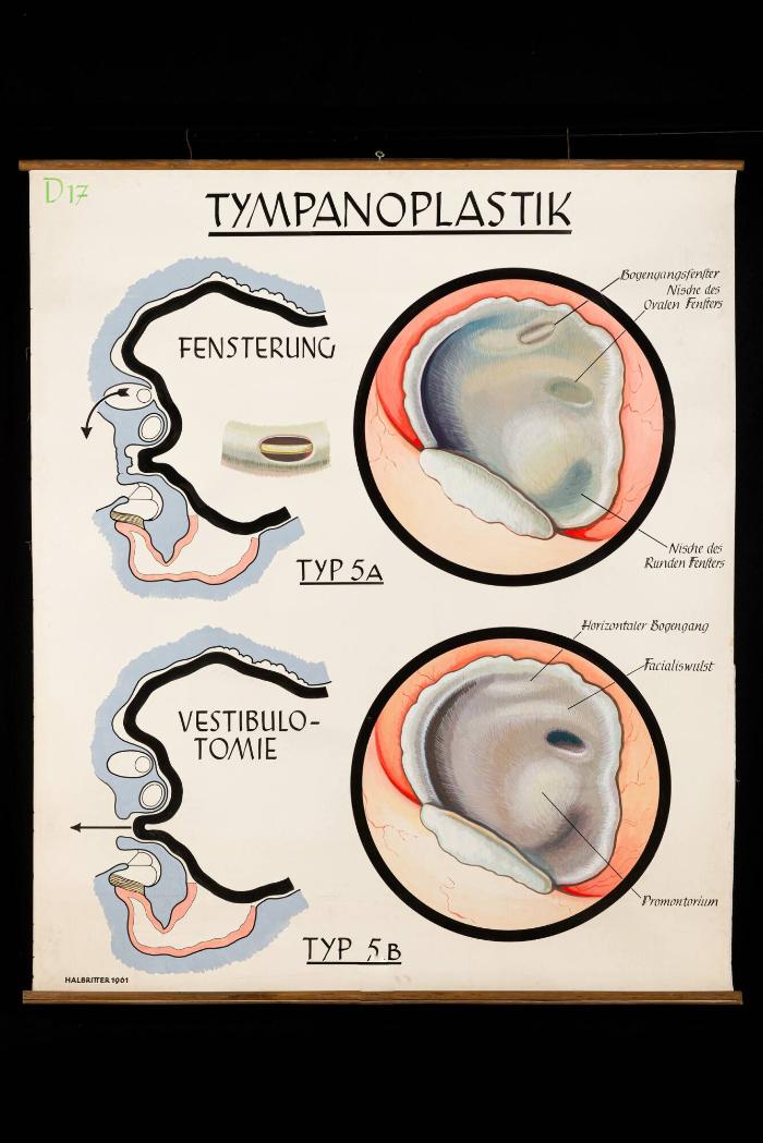 Tympanoplastik, Typ 5