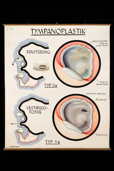 Tympanoplastik, Typ 5