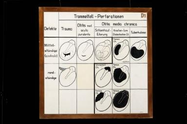 Trommelfell-Perforationen