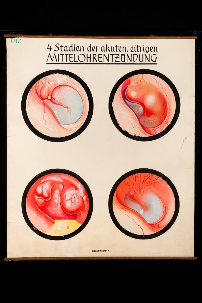 4 Stadien der akuten, eitrigen Mittelohrentzündung