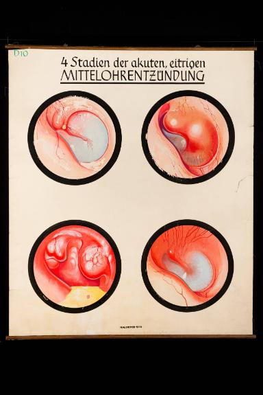 4 Stadien der akuten, eitrigen Mittelohrentzündung
