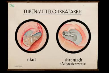 Tubenmittelohrkatarrh