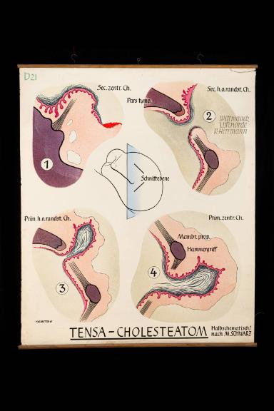 Tensa-Cholesteatom