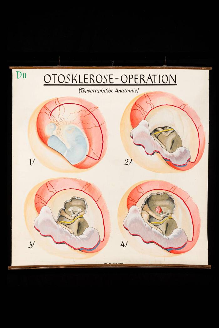 Otosklerose-Operation