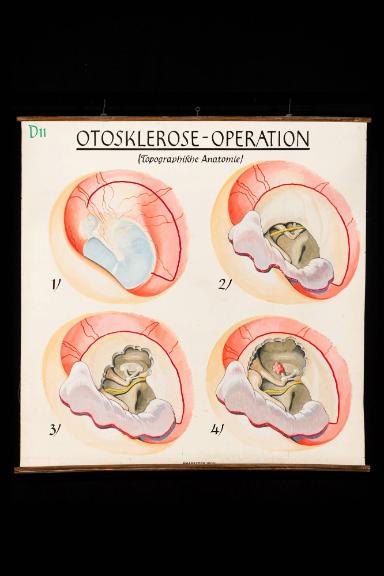 Otosklerose-Operation