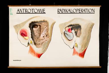 Antrotomie, Radikaloperation