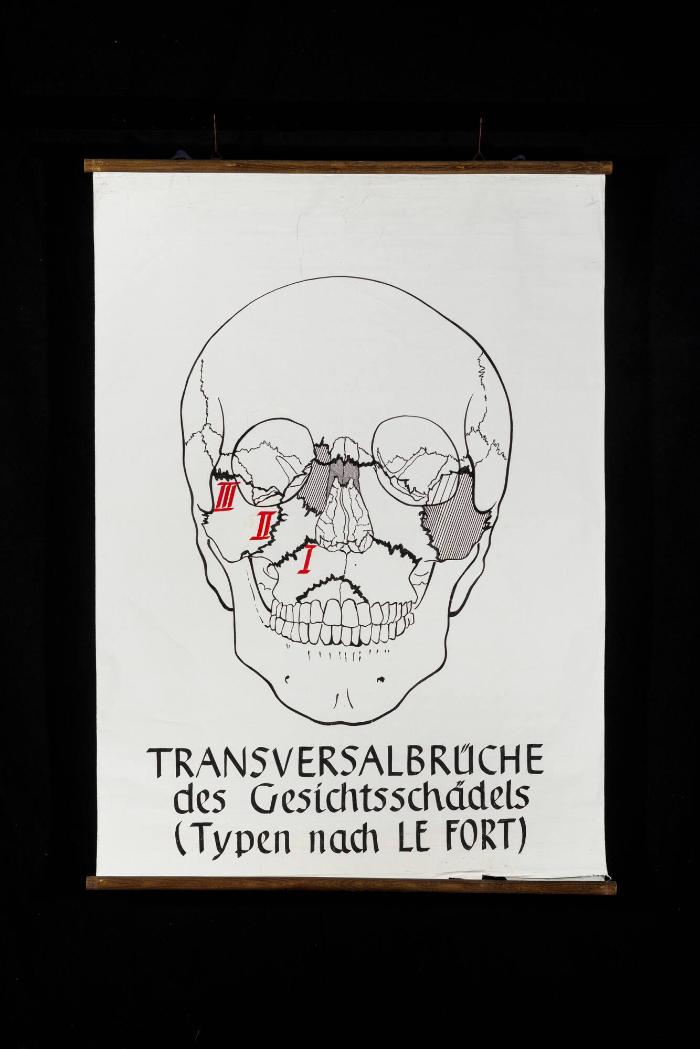 Transversalbrüche des Gesichtsschädels (Typen nach Le Fort)