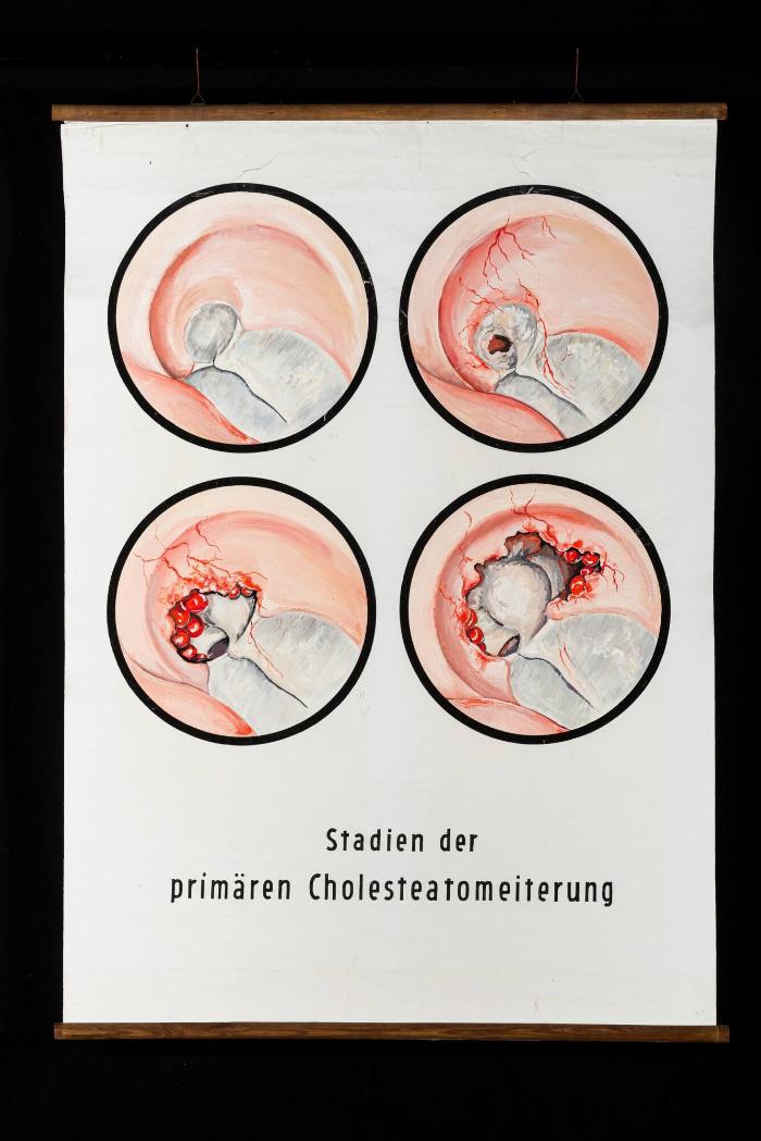 Stadien der primären Cholesteatomeiterung