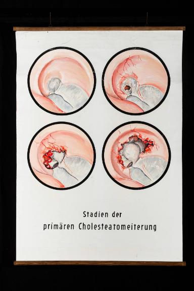 Stadien der primären Cholesteatomeiterung