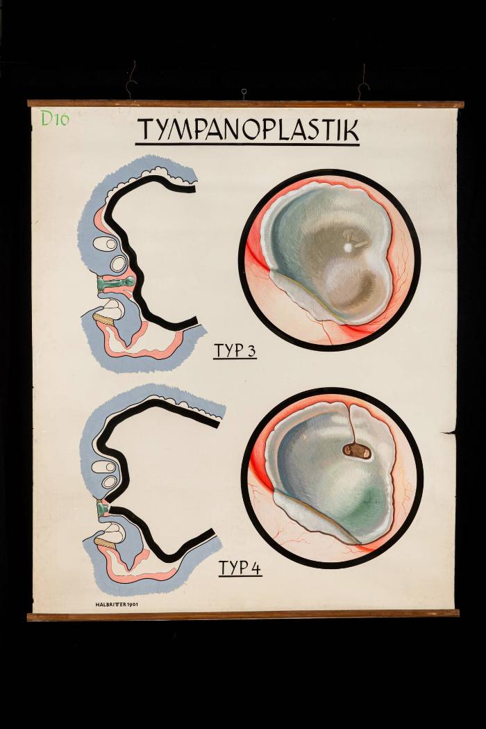 Tympanoplastik, Typ 3 und 4
