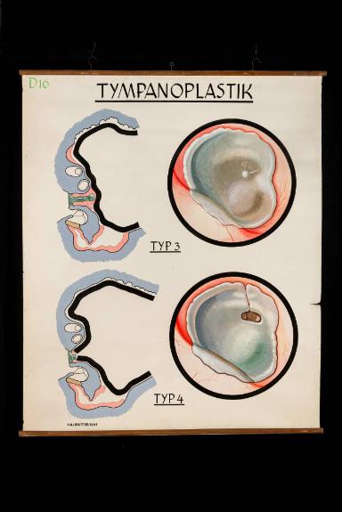 Tympanoplastik, Typ 3 und 4