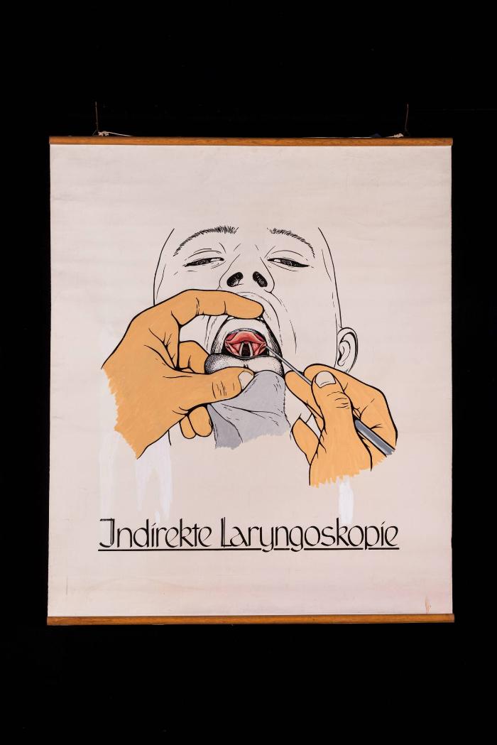Spiegeluntersuchung des Kehlkopfs (Indirekte Laryngoskopie)